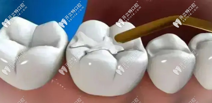 復(fù)合樹(shù)脂