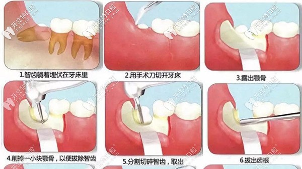 智齒拔除的流程圖