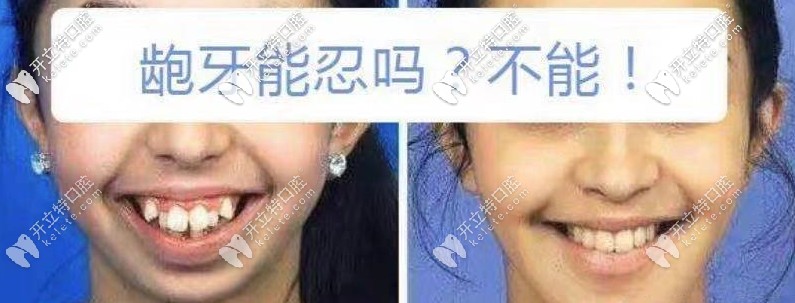 齙牙凸嘴矯正前后對(duì)比圖