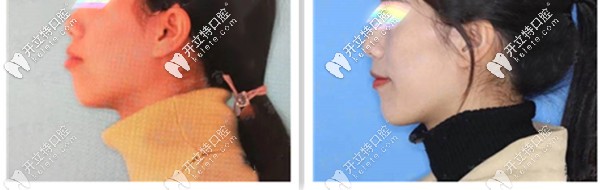 地包天牙齒正畸案例