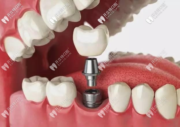種植牙結(jié)構(gòu)示意圖