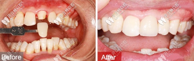 德國進口全瓷牙套價格表get，威蘭德和國產(chǎn)愛爾創(chuàng)哪個好