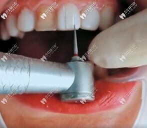 卸除樹脂牙貼面價位大概多少錢一個?水激光卸除價格了解下