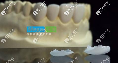 美加超薄瓷貼面