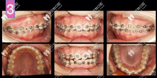 凸嘴自鎖托槽矯正案例