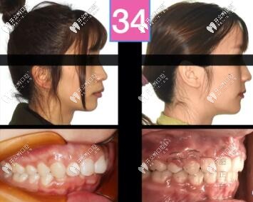 骨性二類凸嘴單純正畸牙齒內收3-4mm側貌效果圖