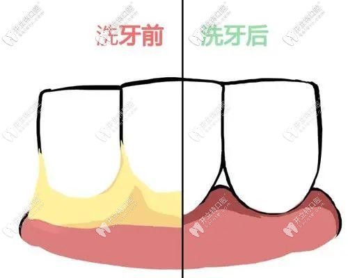 洗牙后牙縫會變大