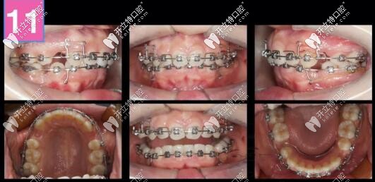 齙牙深復合牙齒矯正案例