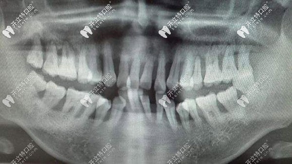 這就是侵襲性牙周炎的牙片