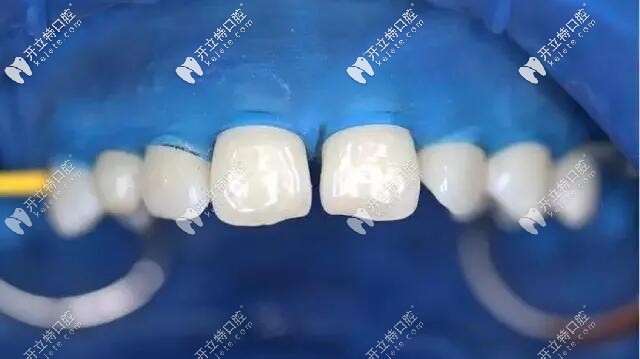 牙科為什么要用橡皮障?橡皮障隔濕的優(yōu)點(diǎn)和收費(fèi)都在這兒