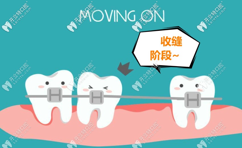 拔牙后矯正牙收縫怎么收回去的?若正畸拔牙四個(gè)收縫要多久