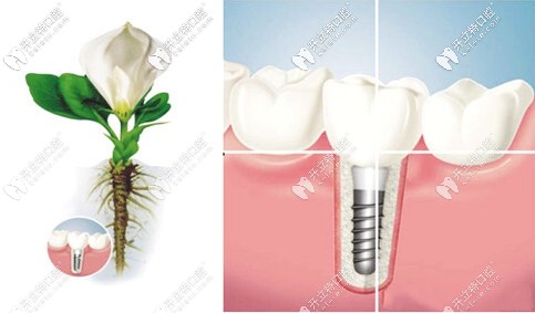 國產(chǎn)和韓系種植牙如登騰奧齒泰哪個較便宜？4000塊就能種的