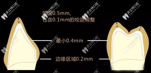 德國進(jìn)口材料的格萊美全瓷牙價格