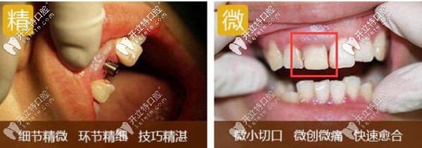 登特口腔德國種植牙醫(yī)生舒斯特的精準(zhǔn)微創(chuàng)種植牙案例