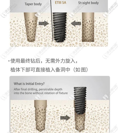 美國皓圣ETIII SA種植體的優(yōu)勢(shì)