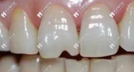 常吃堅(jiān)果會(huì)加速牙齒的磨耗，使牙齒出現(xiàn)裂紋