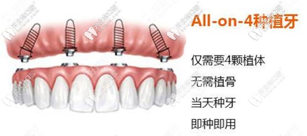 滿口allon4/6即刻負(fù)重技術(shù)