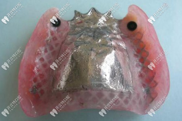 全口半固定種植技術(shù)