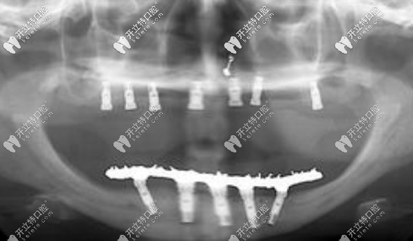 滿口傳統(tǒng)種植技術(shù)