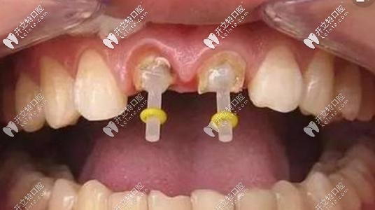 牙齒打樁示意圖