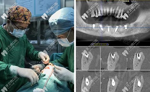 只需5顆種植體就能恢復(fù)半口牙齒