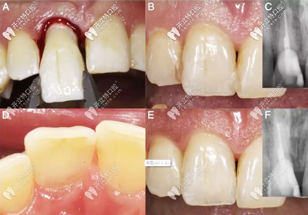 意向性牙再植術(shù)的預(yù)后示意圖