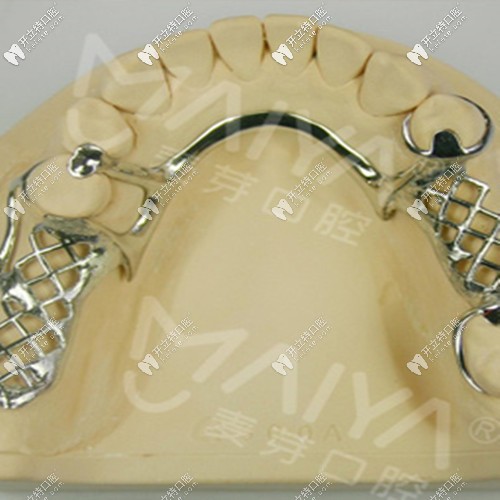 掛鉤活動(dòng)假牙