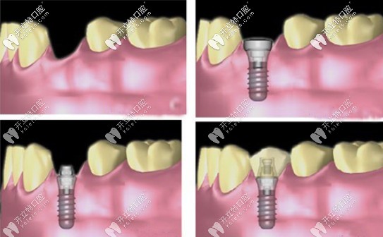 種植牙過(guò)程