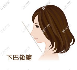 誰知道齙牙矯正后能改善齒性齙牙下巴后縮嗎？怎么矯正好