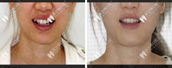 矯正前后對比圖一