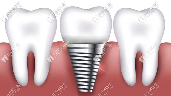 邢臺種植牙價格