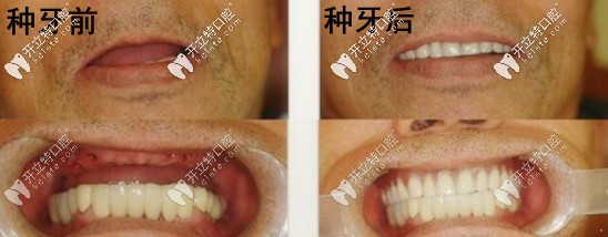 半口種植牙的前后對(duì)比