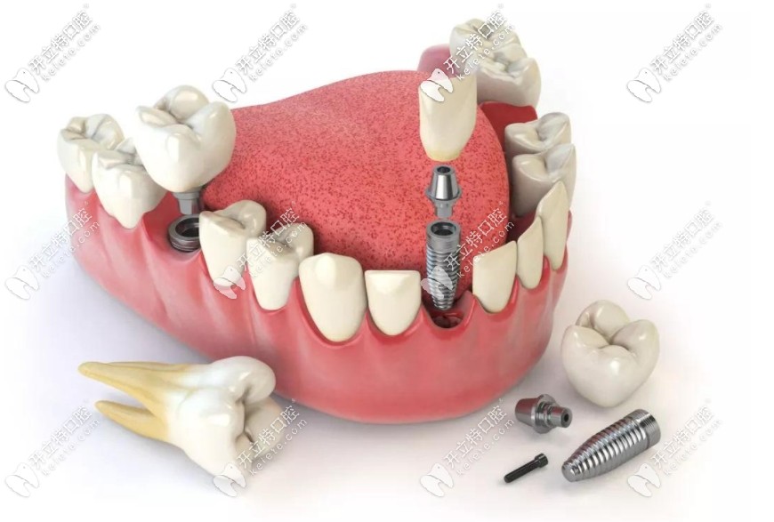 種植牙結構