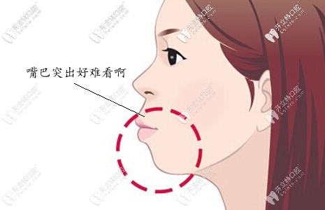齙牙凸嘴千萬不要戴牙套?我骨性凸嘴戴牙套就收回3mm,歐耶