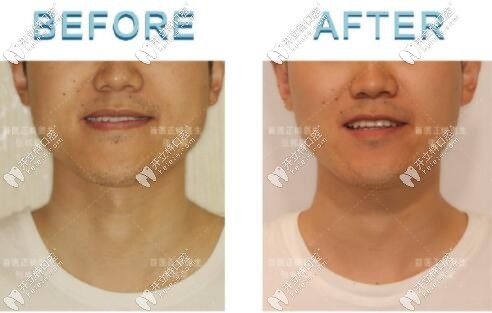 成人骨性地包天矯正后正臉變化對比