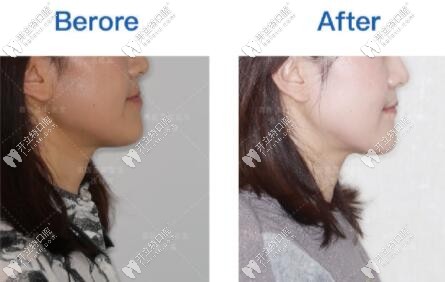 小姐姐矯正地包天后側(cè)臉的對比圖
