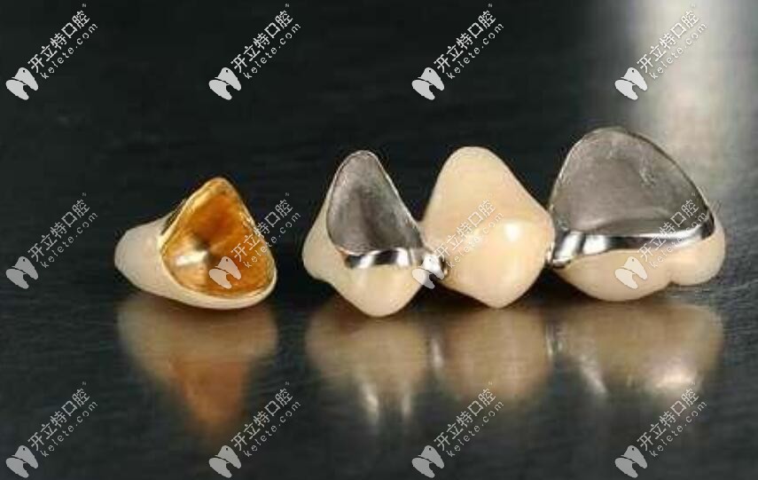 烤瓷牙600和800元、1200塊的區(qū)別在哪？?jī)r(jià)格貴質(zhì)量就好？