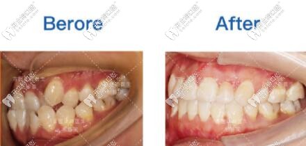 首<!--<i data=20240703-sp></i>-->張棟梁矯正案例對比