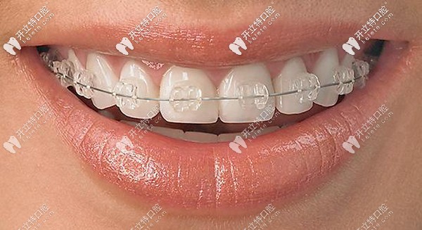 陶瓷半隱形矯正