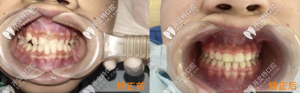 矯正牙齒前后對(duì)比