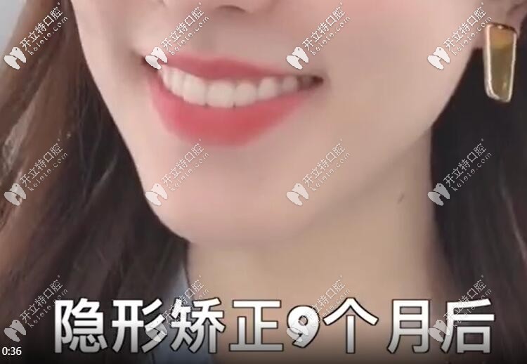 門牙不齊帶隱形牙套矯正9個(gè)月效果圖