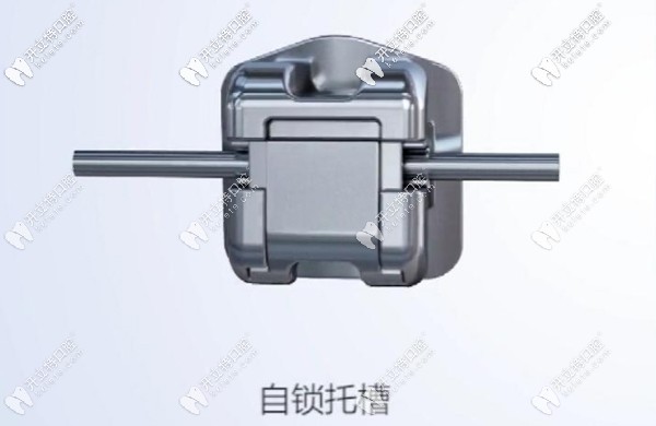 金屬自鎖托槽