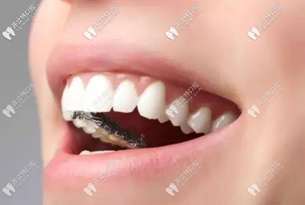 舌側(cè)隱形矯正