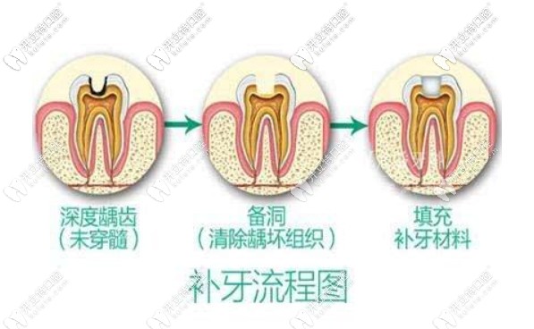 補(bǔ)牙流程