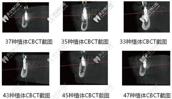 各牙齒種植體在CBCT中顯示的樣子