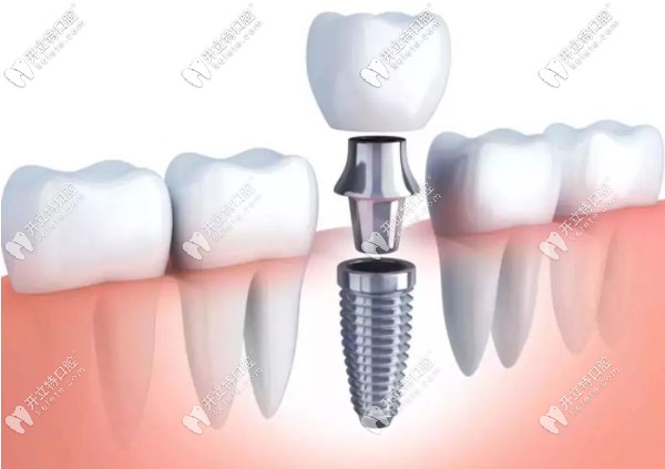 廣州德道口腔的種植牙宣傳圖