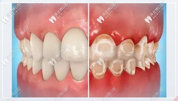 不建議長(zhǎng)期使用小蘇打刷牙 ，會(huì)損害牙釉質(zhì)，破壞牙本質(zhì)。