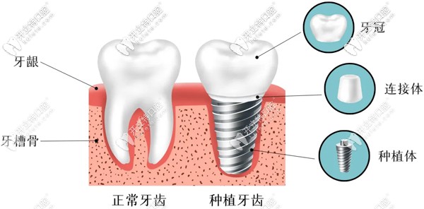 種植牙較佳年齡建議17歲到70歲