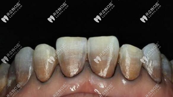瑞典全瓷冠對圖片中的重度四環(huán)素牙有不錯(cuò)效果