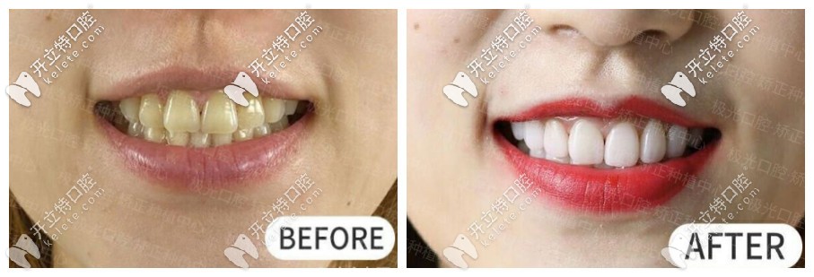 牙齒貼面前后對比圖